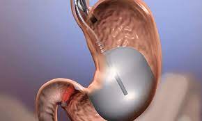 BALON gastrico en puebla