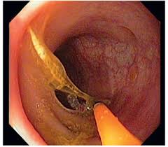 Diagnostico y tratamiento de hemorragia y tubo digestivo