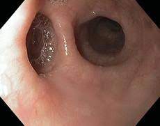 Divertículo esofágico