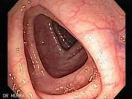 colonoscopia en puebla