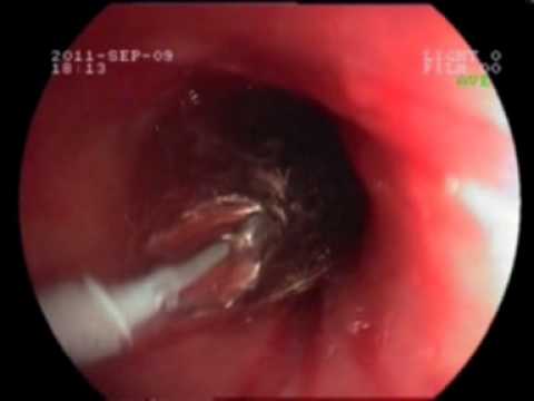 dilatacion esofagica